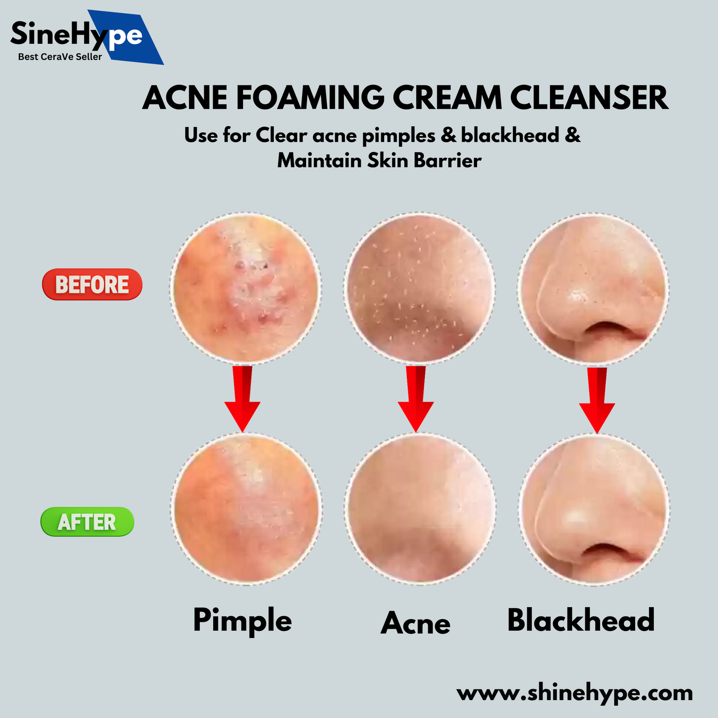 Acne Foaming Cream Cleanser